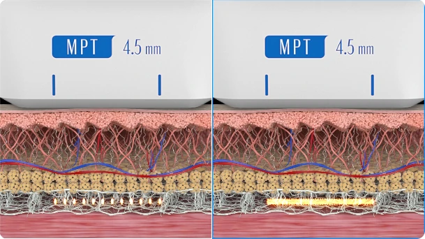 SMAS층(4.5mm) 집속초음파 도해 — Normal mode와 MP mode